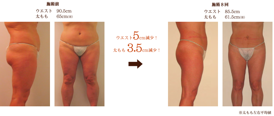 キャビテーションのボディメイク効果